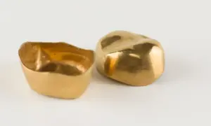 Gold crown tooth cost alt